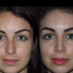 Breathe Freely Again: Trust the Best Septoplasty Surgeon in Dubai