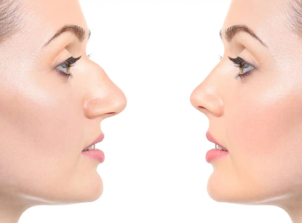 Best Rhinoplasty Surgeon in Dubai: Crafting Natural and Refined Results