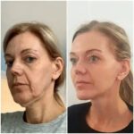 Feel Beautiful: Best Aesthetic Clinics in dubai Profhilo