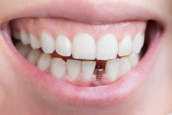7 Reasons to Replace a Missing Tooth in Southampton