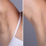 Best Doctors in Dubai for Laser Hair Removal: How to Choose the Right Clinic
