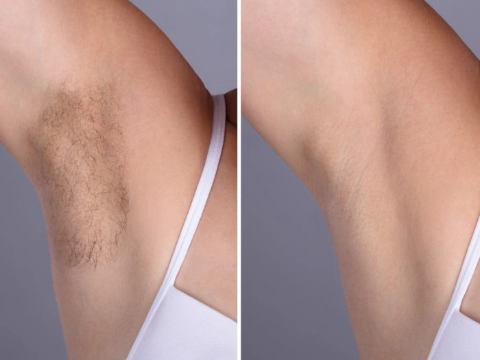 Laser hair removal Treatments in Dubai: The Secret to Effortless Elegance