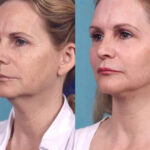 Chemical Peel Treatments in Dubai: Before and After Results Explained
