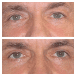 Eye Bag Removal in Dubai: Eye Bag Removal for Busy Professionals