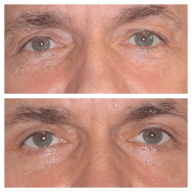 Eye Bag Removal in Dubai: Eye Bag Removal for Busy Professionals