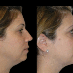 Double chin removal in Dubai: Natural alternatives