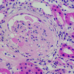 Beyond the Scar: Identifying FSGS Risk Factors and Treatment Strategies