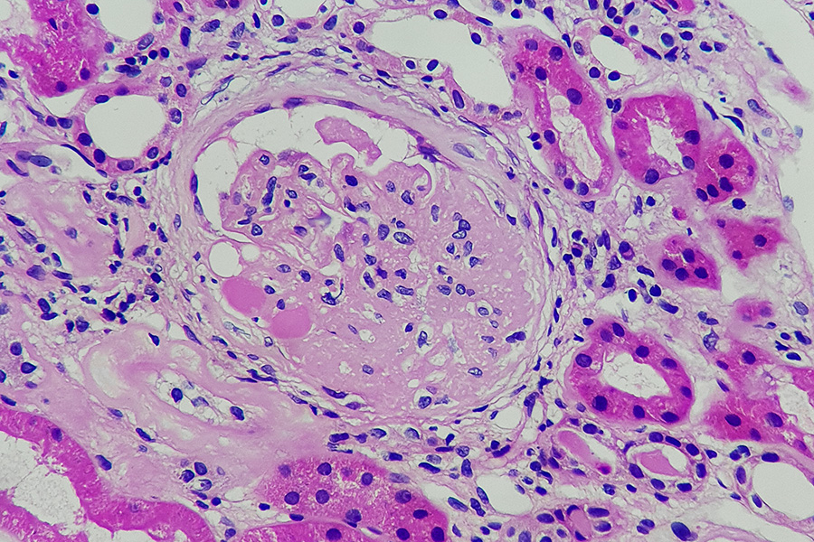 Beyond the Scar: Identifying FSGS Risk Factors and Treatment Strategies