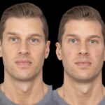 Under Eye Fillers Real Results from Best Plastic Surgeon in Dubai