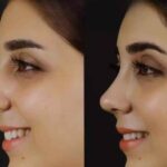 Why Patients Choose the Best Doctors in Dubai for Septoplasty Surgery