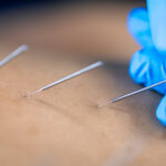 How Acupuncture Helps Improve Fertility Naturally
