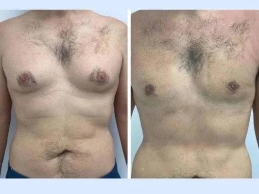 The Role of Estrogen in Male Breast Enlargement and Gynecomastia Surgery in Dubai