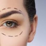 Rejuvenate Eye Area with Upper Blephroplasty in Jeddah