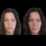 Jawline Fillers in Dubai: Comparing Different Filler Types and Their Benefits