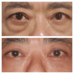 Permanent Eye Bag Removal Solutions from the Best Doctors in Dubai