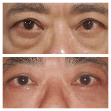 Permanent Eye Bag Removal Solutions from the Best Doctors in Dubai