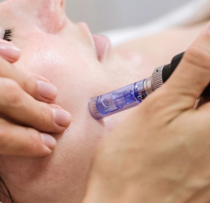 Get Flawless Skin Naturally with Microneedling in Manchester