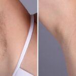Best Plastic Surgeon in dubai for Laser Hair Removal: Is It Worth the Hype?