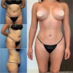 Body Contouring in Dubai: Excellence at Every Step