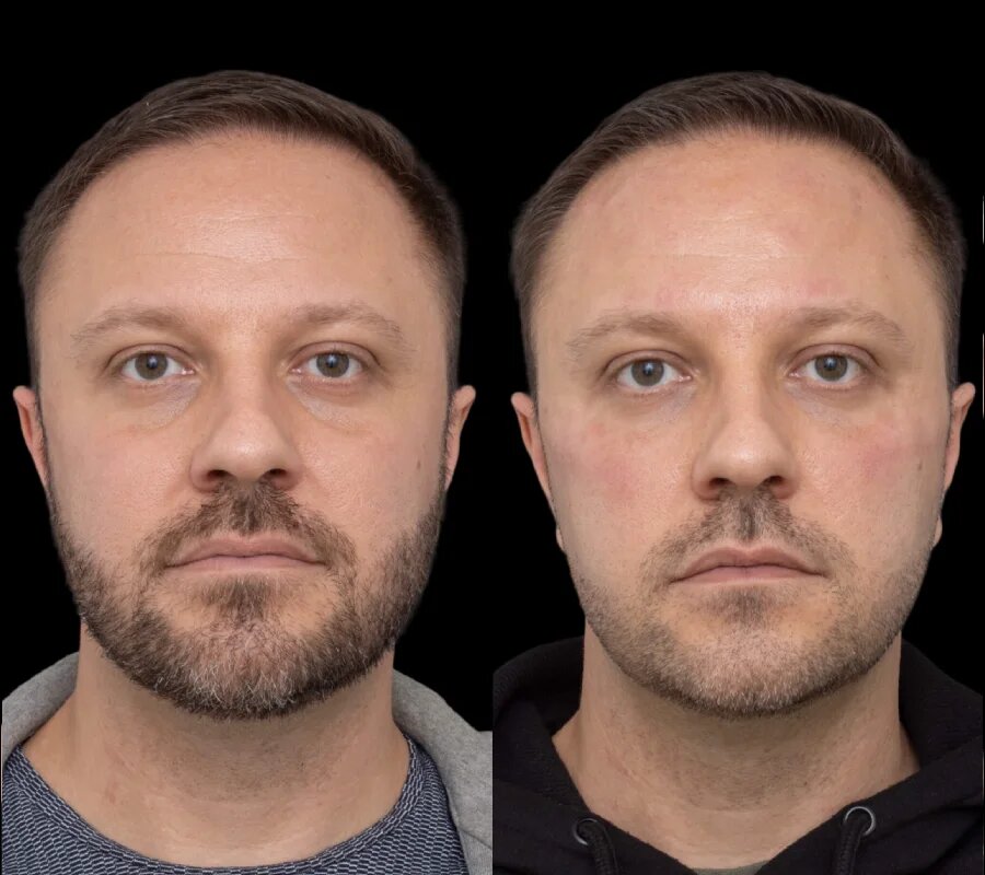 Quick Recovery Tips After Under Eye Fillers Treatment in Dubai