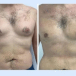 Gynecomastia in Dubai: Choosing Between Liposuction, Gland Excision, or Combination Surgery