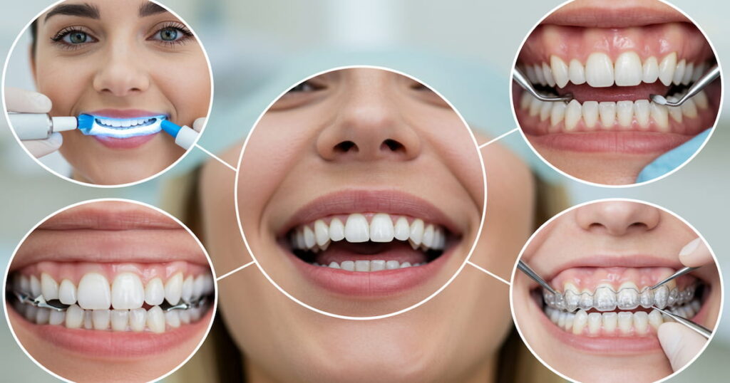 Popular Cosmetic Dental Options Explained for Patients