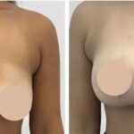 Breast Lift Surgery in dubai: Graceful Results Through Expertise