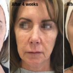 Can Profhilo Be Used Alongside Medical-Grade Skincare?