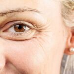 At What Age Is Brow Lift Surgery Usually Recommended?