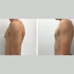 Gynecomastia Surgery in Dubai: Male-Focused Aesthetic Care