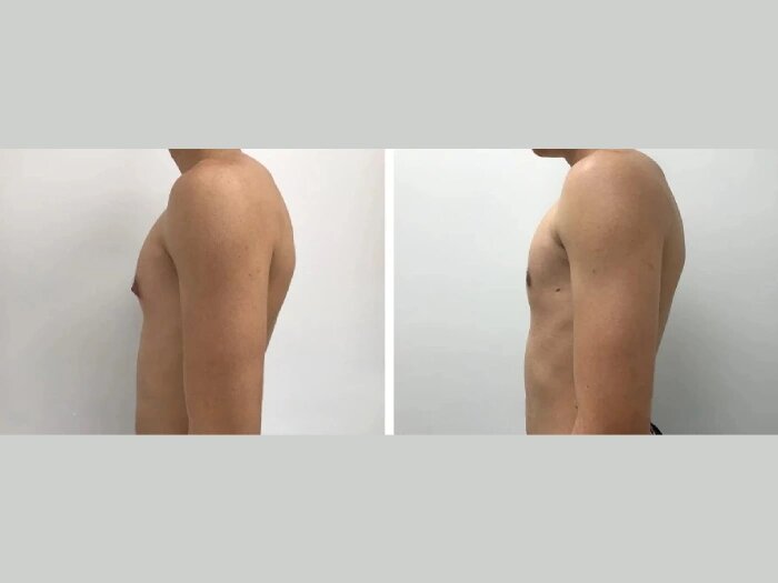 Gynecomastia Surgery in Dubai: Male-Focused Aesthetic Care