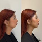 Chin Botox Before and After: Amazing Makeover Ideas