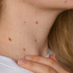 Are Skin Tags Contagious? Facts You Must Know