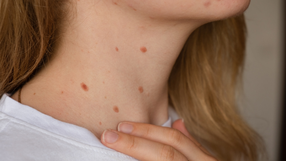 Are Skin Tags Contagious? Facts You Must Know