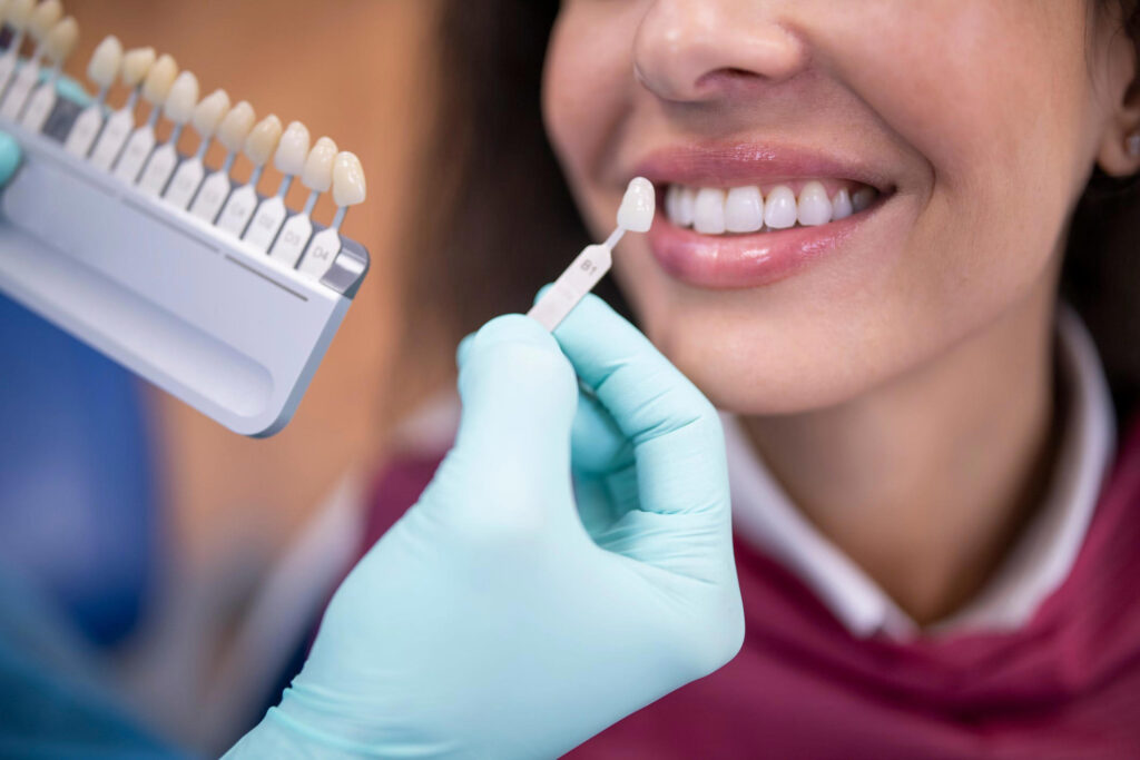 Are Dental Veneers Worth It? Benefits, Process, and Results Explained