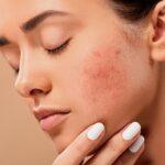 What Areas of the Body Can Be Treated With Microneedling?