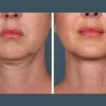 Best Plastic Surgeon in Dubai PRP Youthful Skin