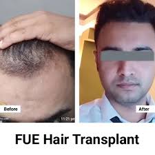 Hair Transplant Treatment in Faisalabad – Advanced & Permanent Hair Restoration Solutions