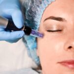 Can SkinPen Microneedling Improve Fine Lines and Wrinkles?