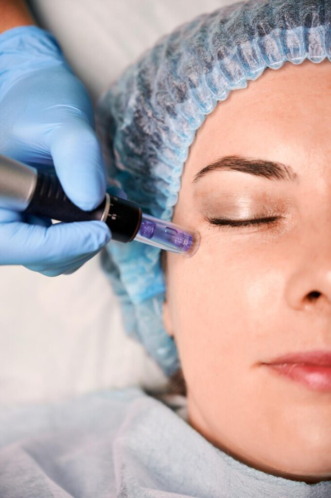Can SkinPen Microneedling Improve Fine Lines and Wrinkles?