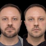 Under Eye Fillers for Smooth Eye Contours by Best Plastic Surgeons in Dubai