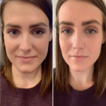 Best Plastic Surgeons in Dubai PRP Treatment for Hairline Improvement