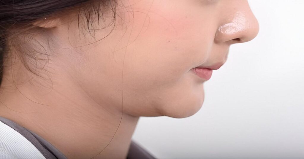 Double Chin Liposuction in Islamabad for Jaw Sculpting