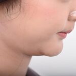 Double Chin Liposuction in Islamabad for Jaw Sculpting