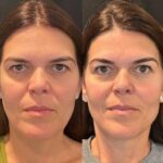 Thread lift treatment in Dubai: Before and after results you should know