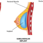 Breast Implants in Ludhiana | Safe & Natural Results