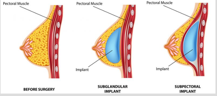 Breast Implants in Ludhiana | Safe & Natural Results