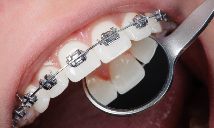 Chembur Braces Specialists – Modern Teeth Straightening Solutions