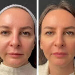 Mesotherapy in Dubai: Anti-Aging Benefits for Face and Neck