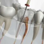 Save Your Smile with Modern Root Canal Treatments